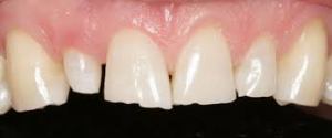 Teeth needing dental veneers